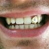 Gold Grillz Miami Call/Text 305.989.6479 www.GoldTeethMiami.com