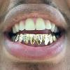 Gold Grillz Miami Call/Text 305.989.6479 www.GoldTeethMiami.com