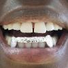 Gold Grillz Miami Call/Text 305.989.6479 www.GoldTeethMiami.com