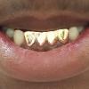 Gold Grillz Miami Call/Text 305.989.6479 www.GoldTeethMiami.com