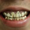 Gold Grillz Miami Call/Text 305.989.6479 www.GoldTeethMiami.com